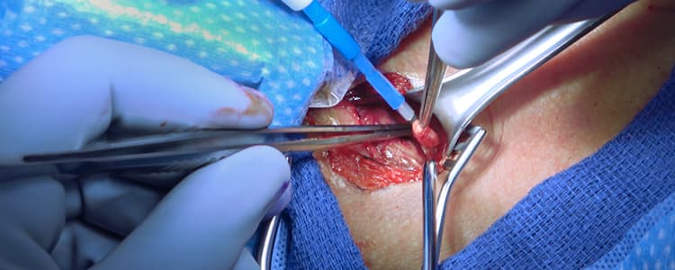 parathyroidectomy-and-four-gland-exploration-for-hyperparathyroidism