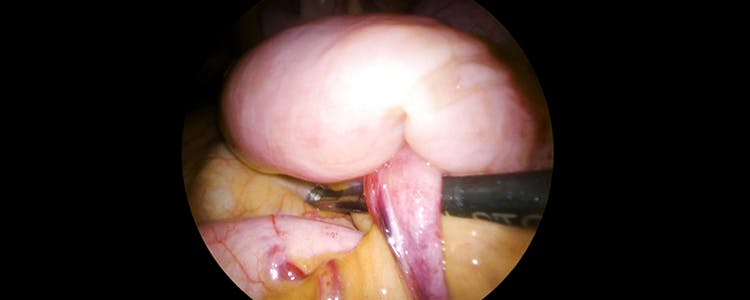 laparoscopic-lysis-of-adhesions-for-closed-loop-small-bowel-obstruction