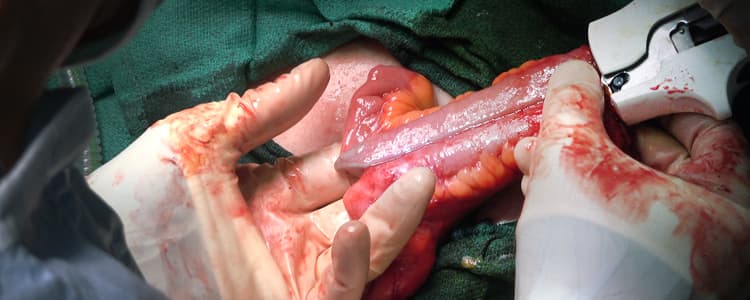 reversal-of-a-diversion-loop-ileostomy-in-a-patient-with-a-prior-gracilis-transposition-flap-for-rectovaginal-fistula-due-to-crohns-disease