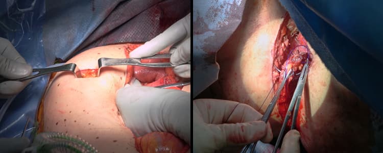 extralevator-abdominoperineal-resection-apr-for-recurrent-anal-cancer-with-an-en-bloc-total-abdominal-hysterectomy-and-bilateral-salpingo-oophorectomy-and-total-vaginectomy-with-permanent-colostomy-formation-and-pelvic-floor-reconstruction