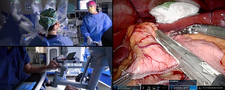 robotic-roux-en-y-gastric-bypass-rygb-for-treatment-of-morbid-obesity