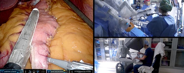 robotic-sleeve-gastrectomy-for-treatment-of-morbid-obesity