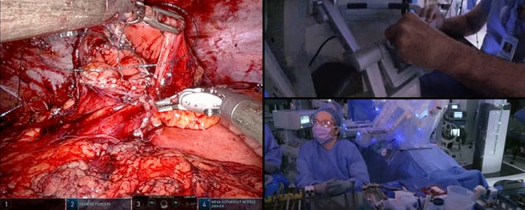 robotic-end-colostomy-reversal