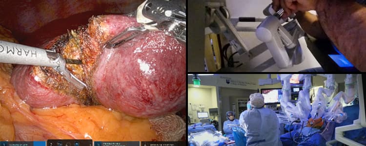 robotic-hepatectomy-for-a-segment-vvi-suspected-hcc-lesion-with-cholecystectomy-and-evaluation-by-ultrasound-and-excisional-biopsy-of-a-segment-ivb-lesion