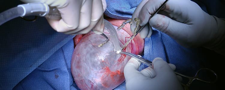 open-hydrocelectomy-for-scrotal-hydrocele