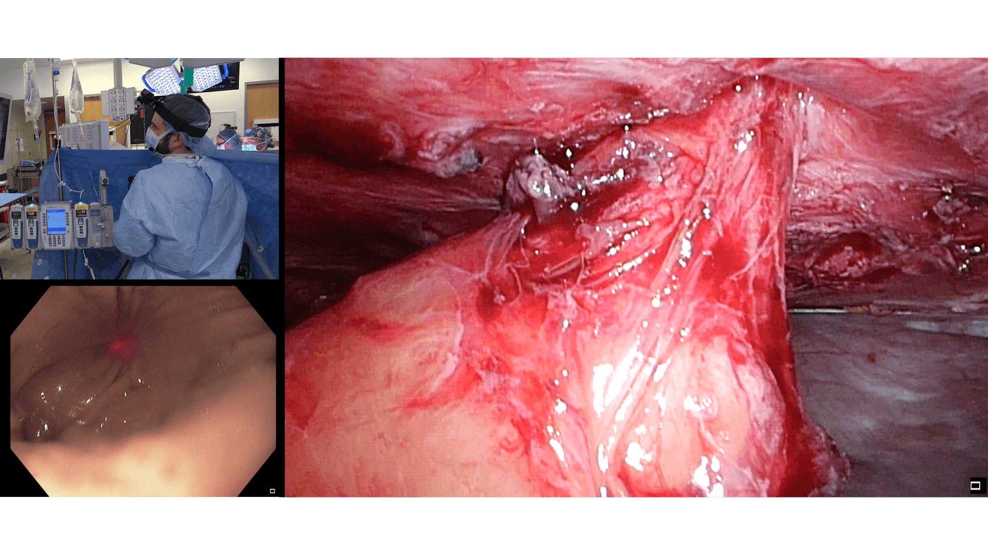 laparoscopic-assisted-takedown-of-a-gastrocutaneous-fistula