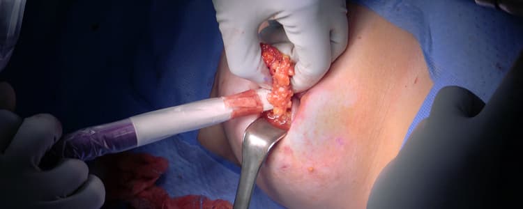 partial-mastectomy-lumpectomy-utilizing-savi-scout-for-a-nonpalpable-papilloma