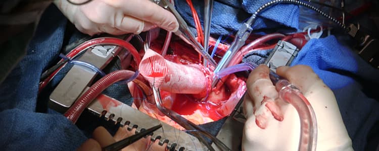 aortic-hemiarch-and-valve-replacement-for-severe-aortic-stenosis-with-ascending-aortic-ectasia