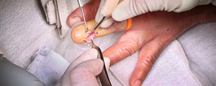 excision-of-a-ganglion-cyst-from-distal-middle-finger-near-nail-bed