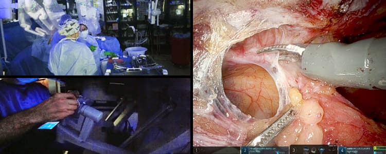 robotic-retromuscular-etep-repair-of-ventral-incisional-hernias-and-diastasis