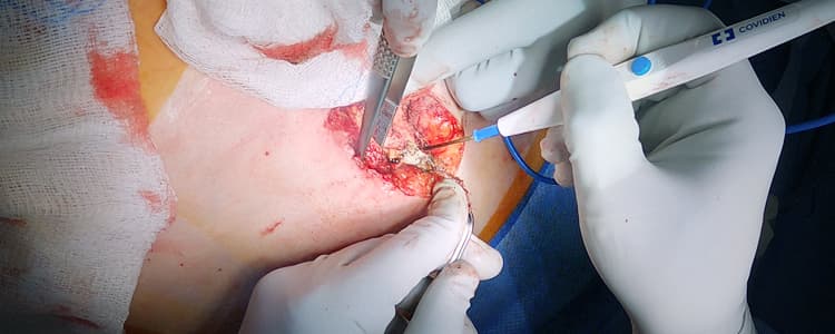 excision-of-infected-onlay-mesh