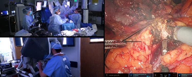 robotic-whipple-procedure-for-an-ampullary-intramucosal-carcinoma