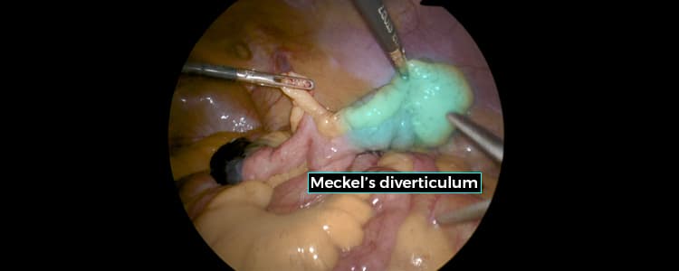 diagnostic-laparoscopy-and-small-bowel-resection-for-a-large-meckels-diverticulum-in-adult-with-persistent-gi-bleed