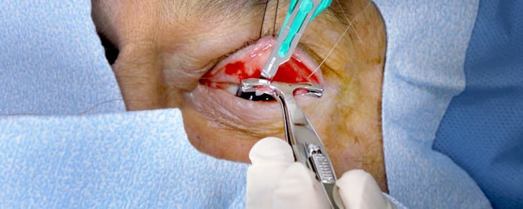 internal-ptosis-repair-by-mullers-muscle-resection