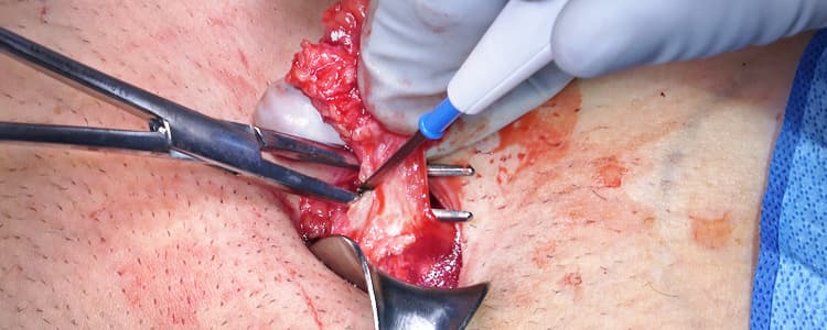 excision-of-suspected-chronic-infected-suture-sinus