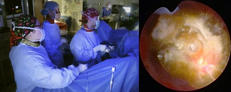 ureteroscopy-and-laser-lithotripsy-for-ureteral-and-renal-stones-in-a-patient-with-a-nephrostomy-tube