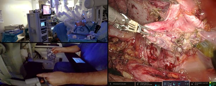 robotic-cholecystectomy-for-chronic-cholecystitis-for-a-patient-with-recurrent-gallstone-pancreatitis-and-a-percutaneous-cholecystostomy-tube