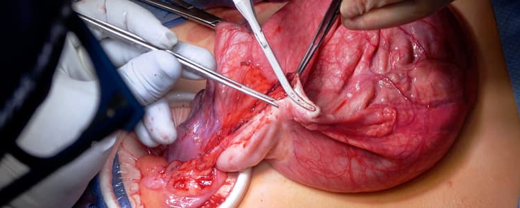 pediatric-exploratory-laparotomy-and-left-ovarian-cystectomy