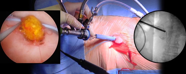 percutaneous-nephrostolithotomy-for-treatment-of-impacted-ureteropelvic-junction-calculus