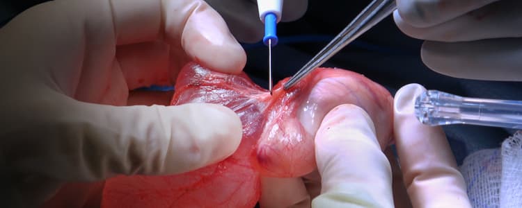 spermatocelectomy-and-partial-epididymectomy-for-a-large-multilocular-spermatocele-and-epididymal-head-cyst