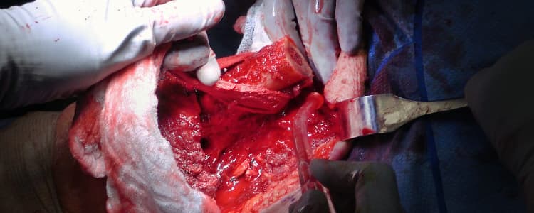 conversion-of-failed-right-leg-below-knee-amputation-to-above-knee-amputation-for-severe-peripheral-arterial-disease