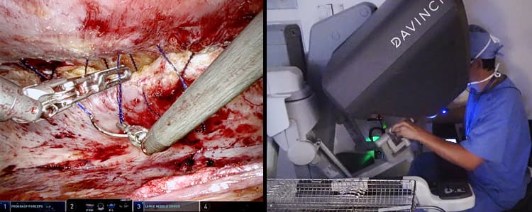 robotic-assisted-transabdominal-preperitoneal-rtapp-repair-for-ventral-hernias