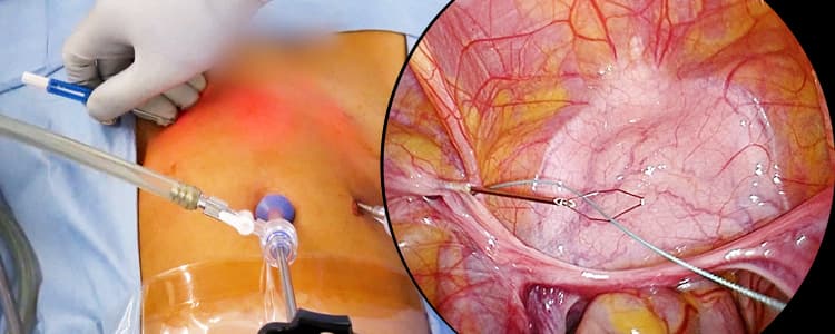 laparoscopic-percutaneous-extraperitoneal-closure-lpec-for-an-inguinal-hernia-in-a-pediatric-female