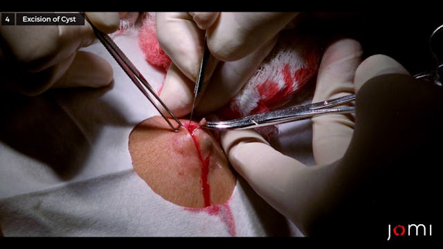 self removal of sebaceous cyst