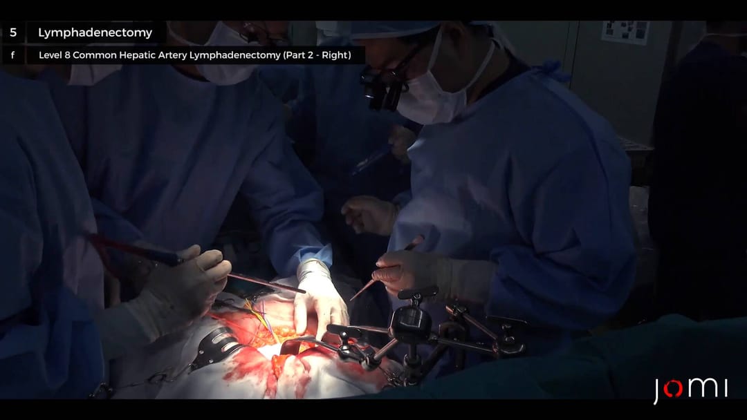 Open Radical Cholecystectomy With Partial Hepatectomy For Gallbladder Cancer Jomi 8212