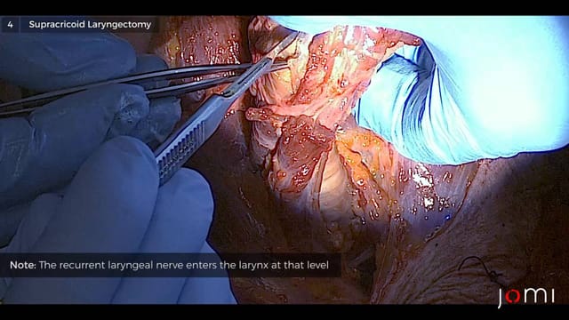 Partial Laryngectomy Techniques (Cadaver) | JOMI