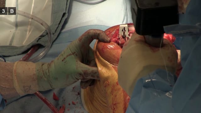 Indent Girl S Video Xxx - Total Knee Arthroplasty | JOMI