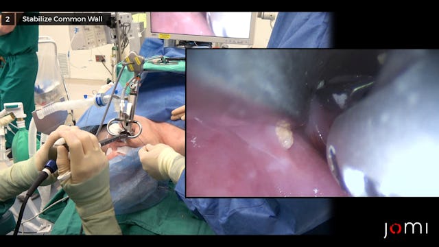 zenker diverticulum laser surgery procedure