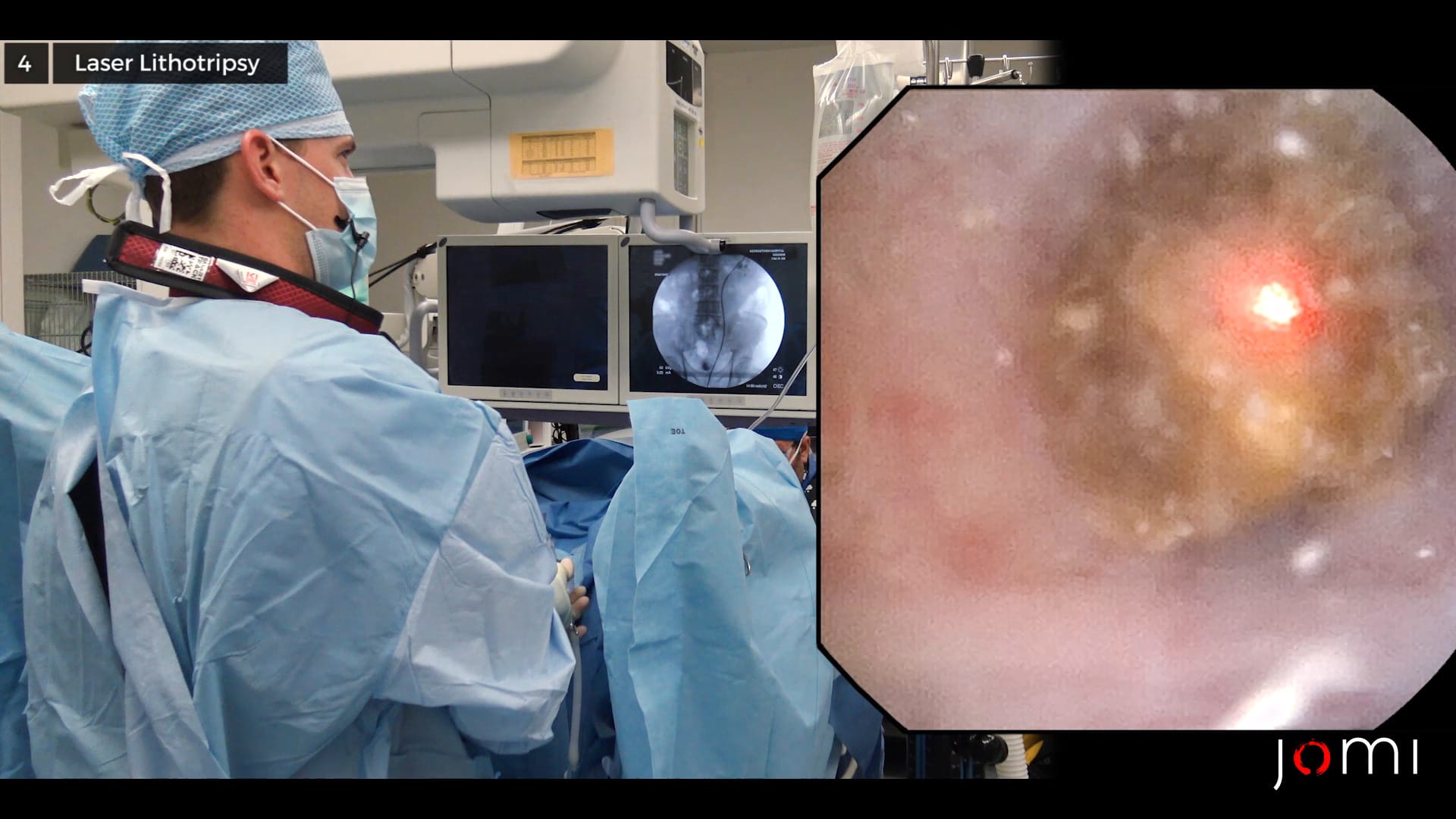 Ureteroscopy, Laser Lithotripsy, and Stent Replacement for an