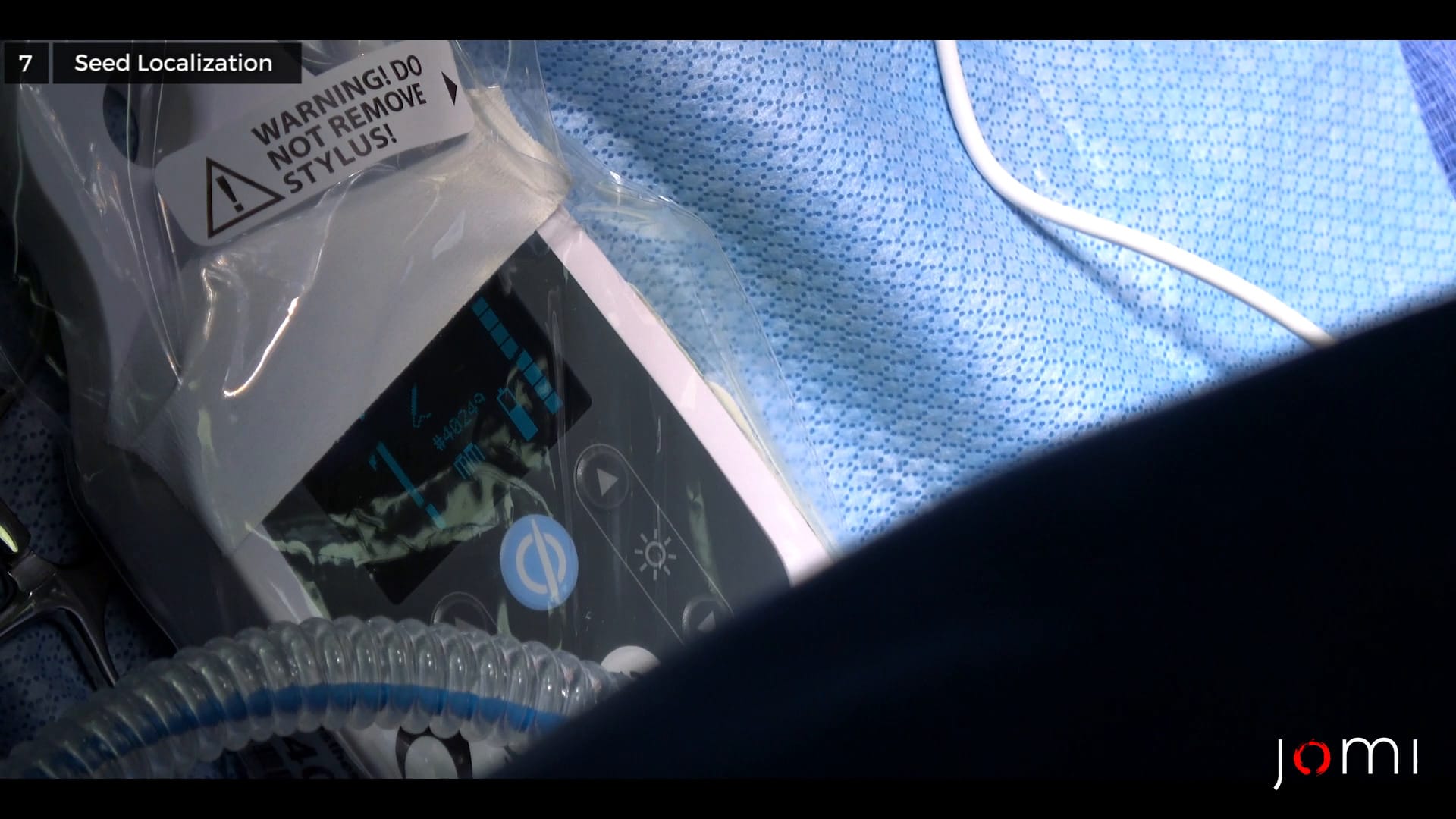 Left Lumpectomy with Wireless Seed Localization for Ductal Carcinoma In