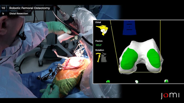 Mako Robotic Arm Assisted Total Knee Arthroplasty Jomi 9625