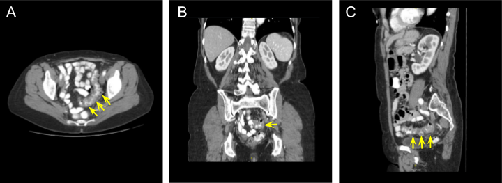 CT scan of the abdomen and pelvis with intravenous and oral contrast revealing evidence of uncomplicated sigmoid diverticulitis. The diseased tissue is shown in (A) axial, (B) coronal, and (C) sagittal views. Yellow arrows point to the diseased segment of colon.