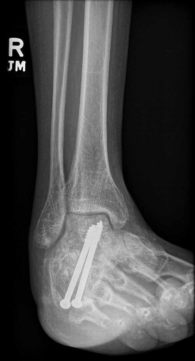 : Röntgenaufnahme des seitlichen Knöchels vor der Operation.                               Postoperative seitliche Knöchelrön