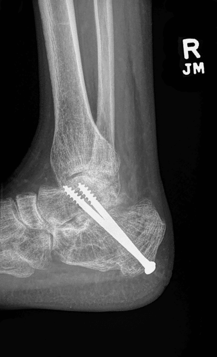 : Radiografía preoperatoria del tobillo lateral.                               Radiografía postoperatoria del tobillo lateral