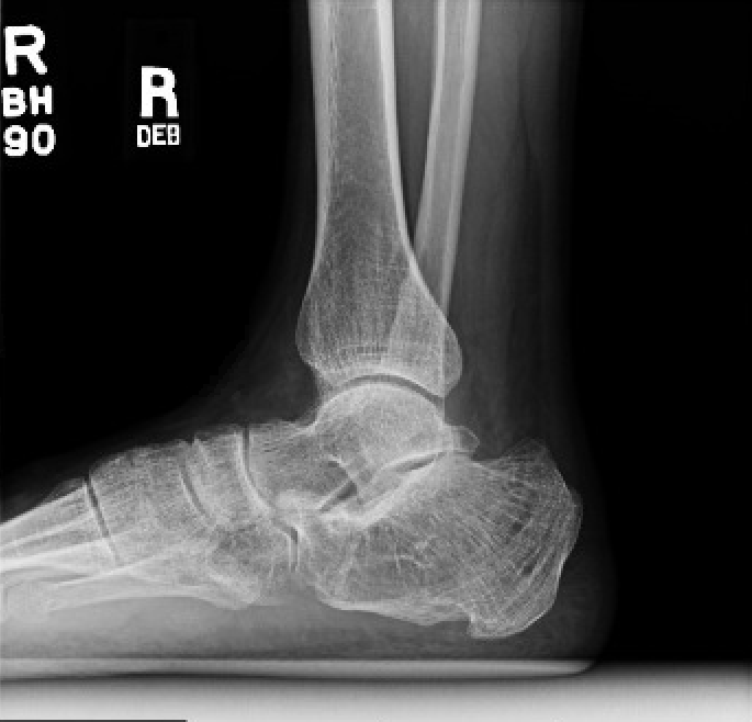 : Röntgenaufnahme des seitlichen Knöchels vor der Operation.                               Postoperative seitliche Knöchelrön