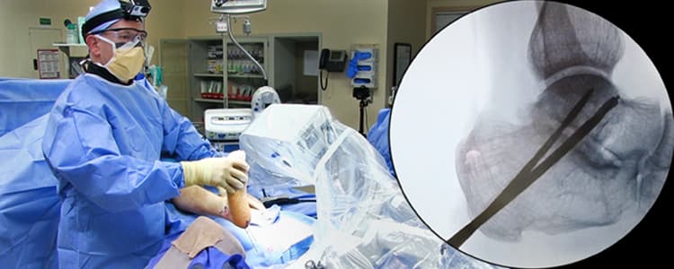 Subtalar Arthrodesis for Post-Traumatic Subtalar Arthritis