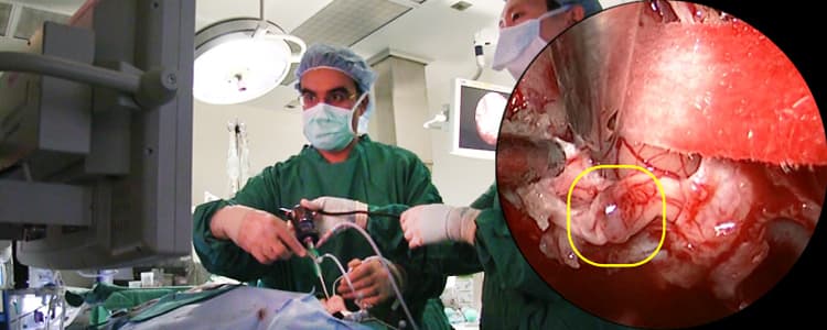 Anterior Skull Base Resection of Esthesioneuroblastoma (Endoscopic)