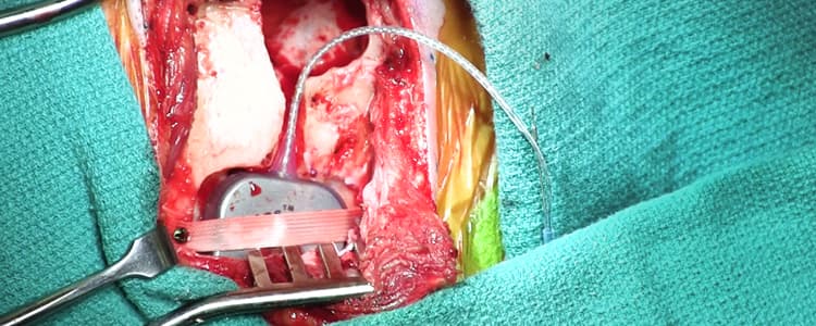 Cochlear Implant