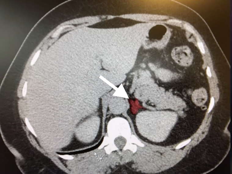 Figure 1.Abdominal CTNon-contrast CT image revealing a lesion (white arrow) in the area of the left adrenal gland.