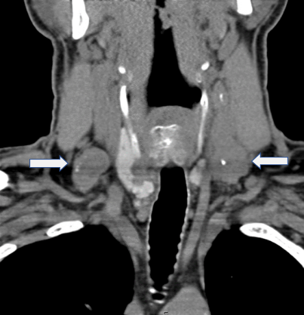 CT scan of the neck from 2014, demonstrating positive lymphadenopathy in the bilateral cervical lymph node compartments.