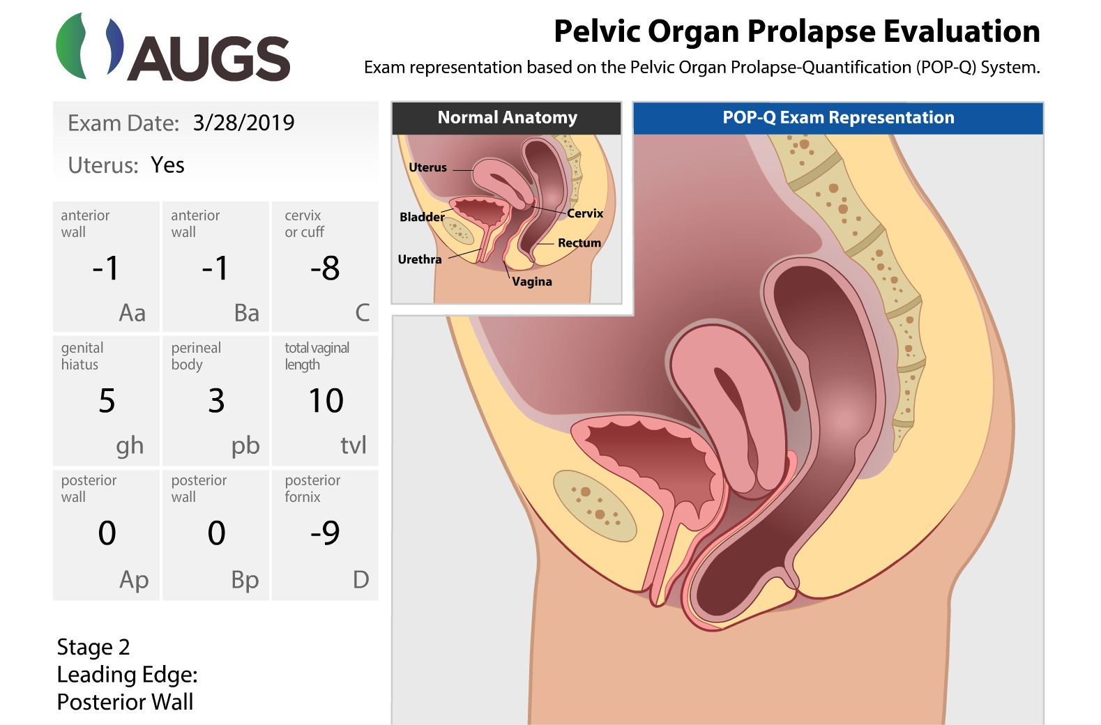 Graphic Demonstration of Preoperative POP-Q Measurements. Used with permission from the American Urogynecologic Society (AUGS).
