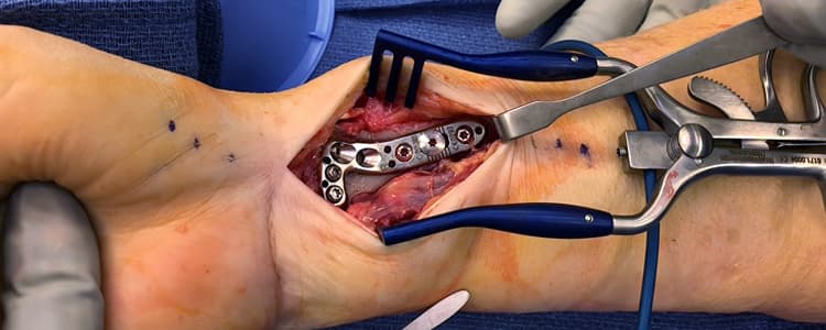 Distal Radius Open Reduction and Internal Fixation