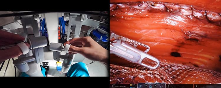 Robotic eTEP Retrorectus Rives-Stoppa Repair for Ventral Hernia