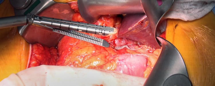Prophylactic Total Gastrectomy for CDH1 Gene Mutation