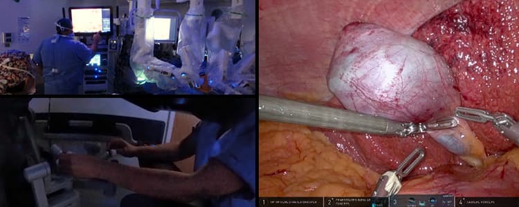 Robotic Cholecystectomy for Porcelain Gallbladder and a 6.8-cm Stone