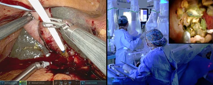Robotic-Assisted Transcystic Endoscopic Common Bile Duct Exploration